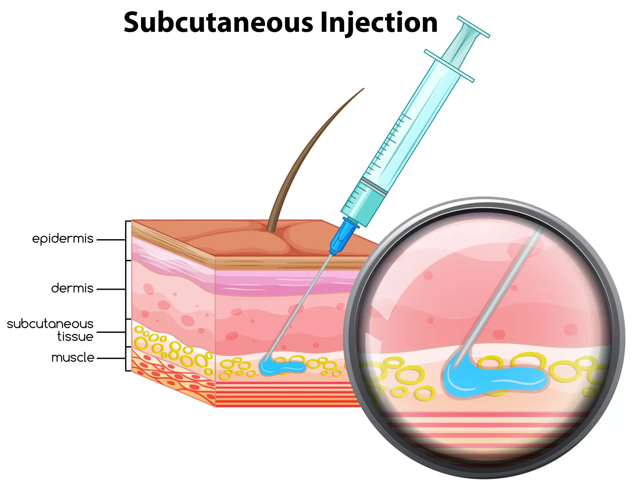 subcutaneous route of drug administration