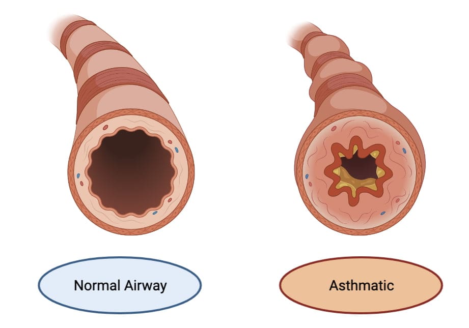 Bronchi in normal and in bronchial asthma
