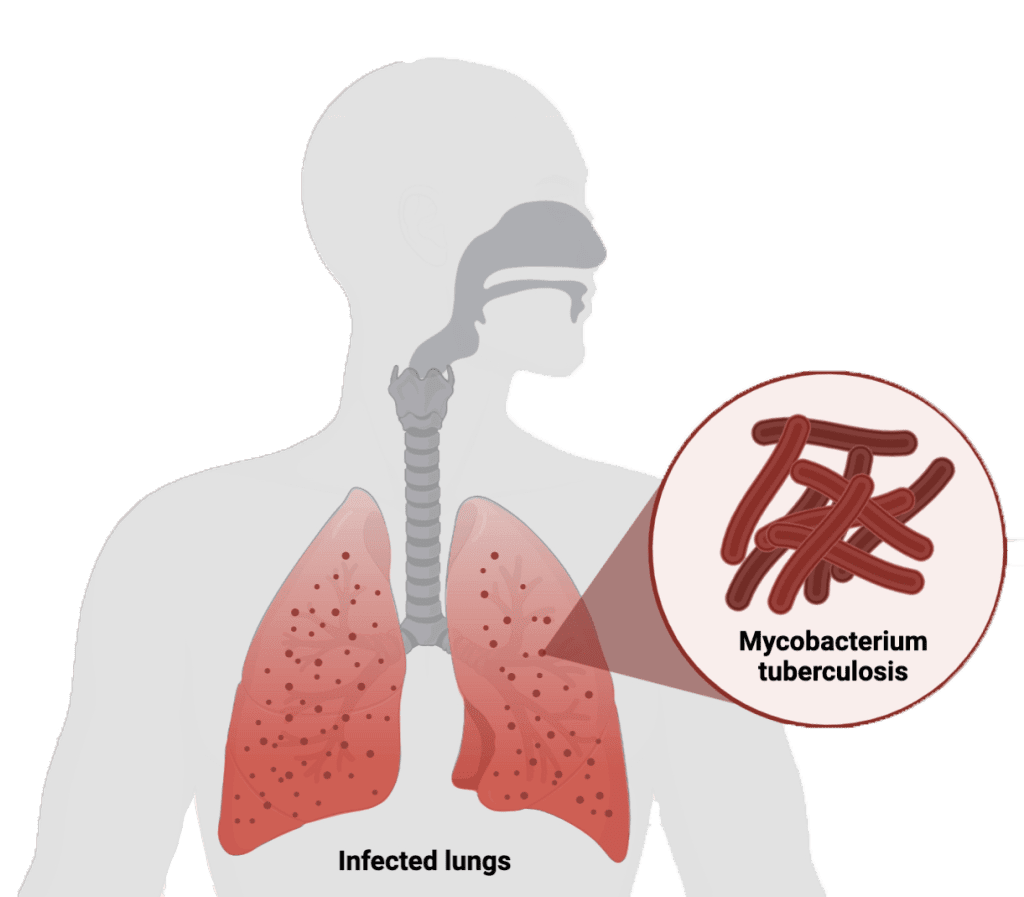 Tuberculosis