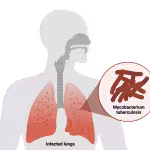 Tuberculosis