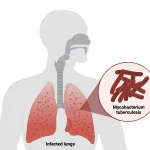 Tuberculosis