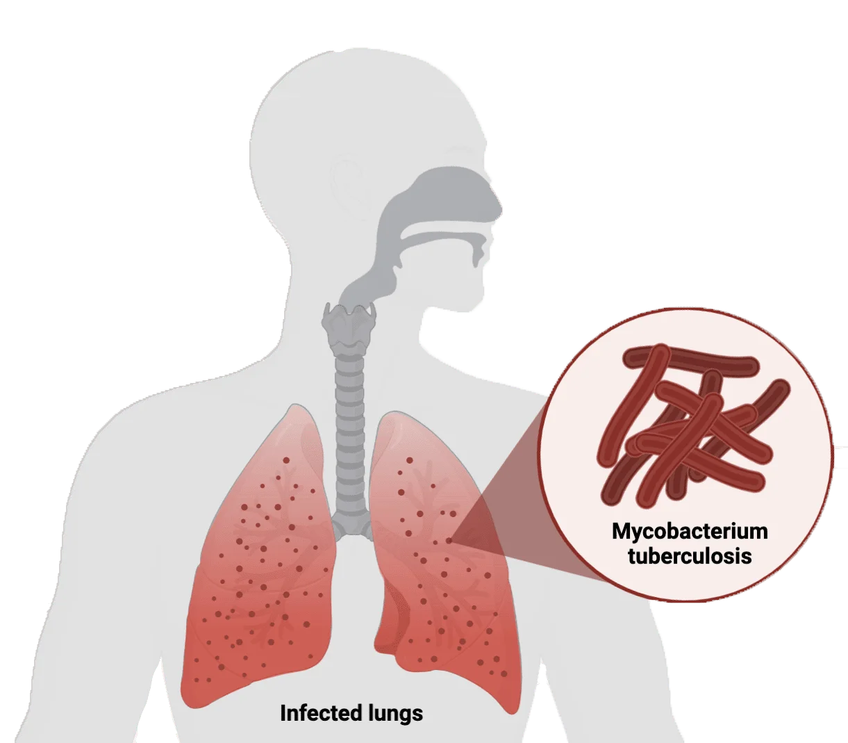 Tuberculosis
