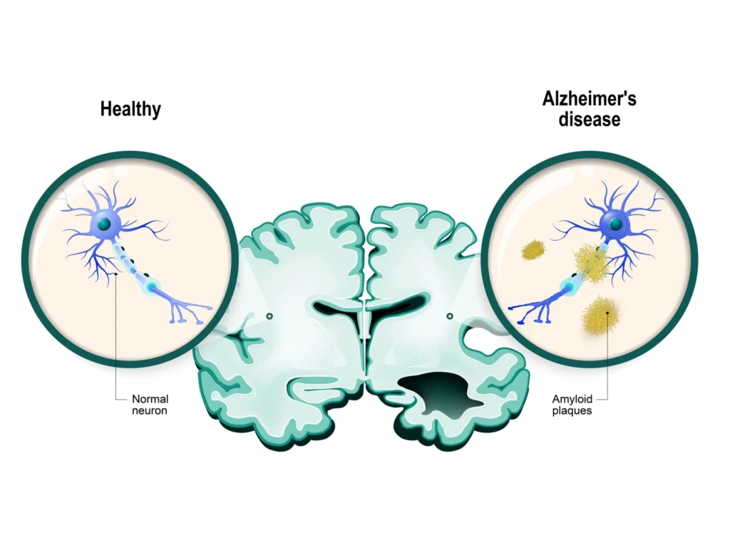 alzheimers disease