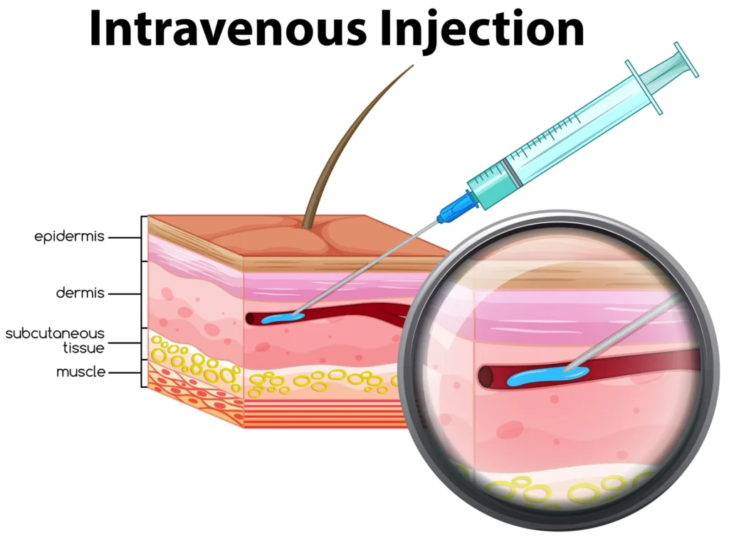 intravenous injection