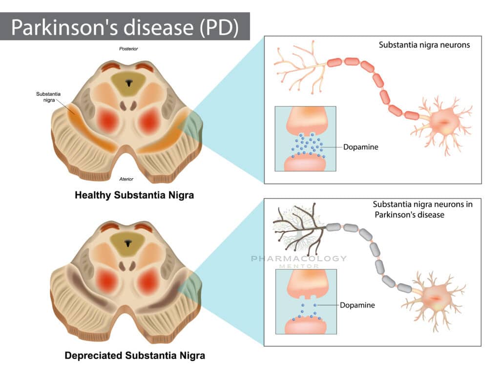 Parkinson's disease