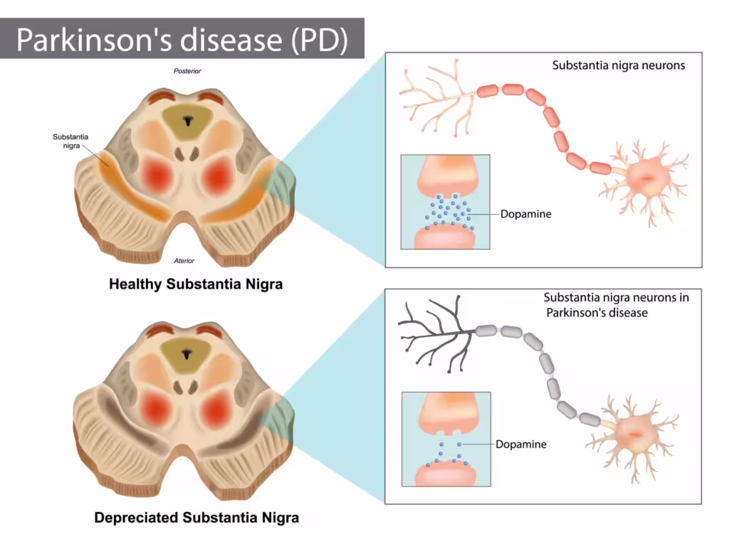 parkinsons disease