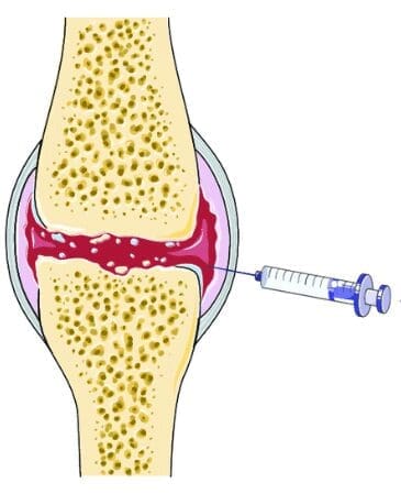 intrarticular-injection-1