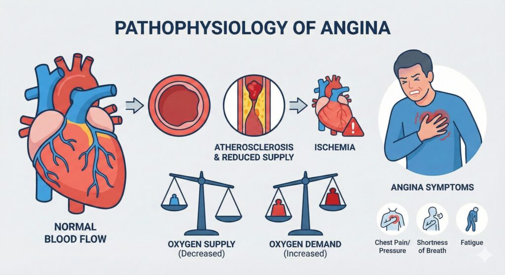 pathophysiology of angina