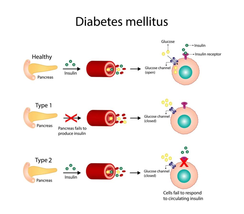 Diabetes mellitus type 1 pancreass failure to produce enough insulin and type 2 cells fail to respond to insulin Insulin resistance Result in high blood glucose levels Vector illustration