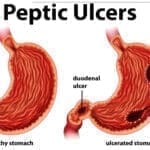 Diagram showing peptic ulcers