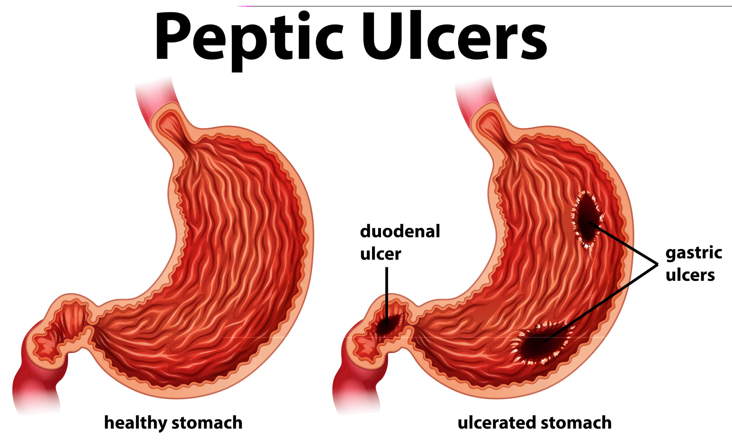 Diagram showing peptic ulcers