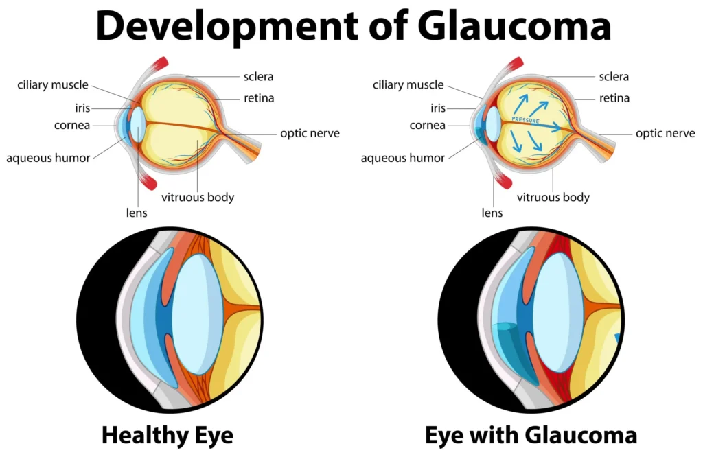 development of glaucoma