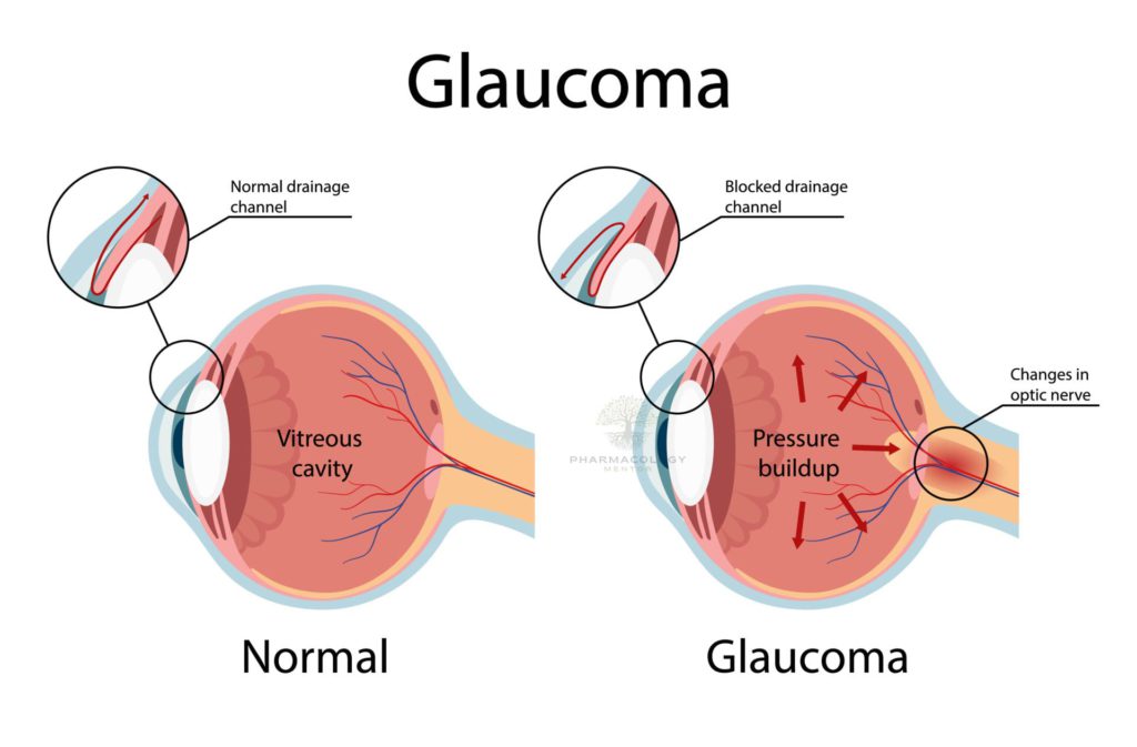 Glaucoma Illustration showing open-angle glaucoma eye anatomy in cartoon style