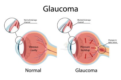 Glaucoma Illustration showing open-angle glaucoma eye anatomy in cartoon style
