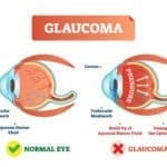 Pilocarpine is used in Glaucoma