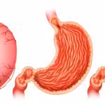 Peptic ulcer disease