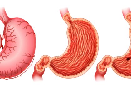 Peptic ulcer disease