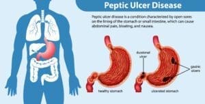 Peptic ulcer disease (PUD)