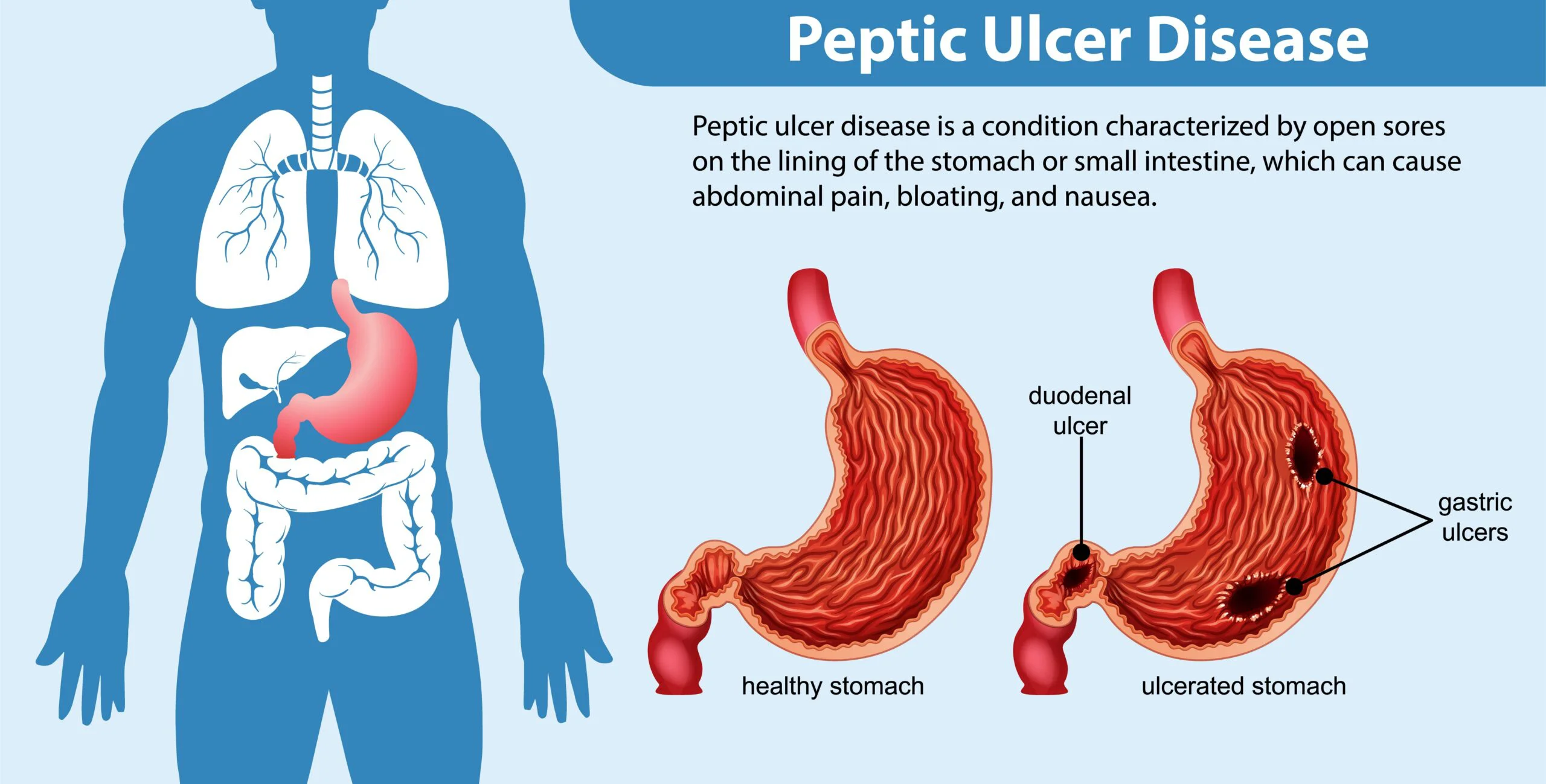 Peptic ulcer disease (PUD)