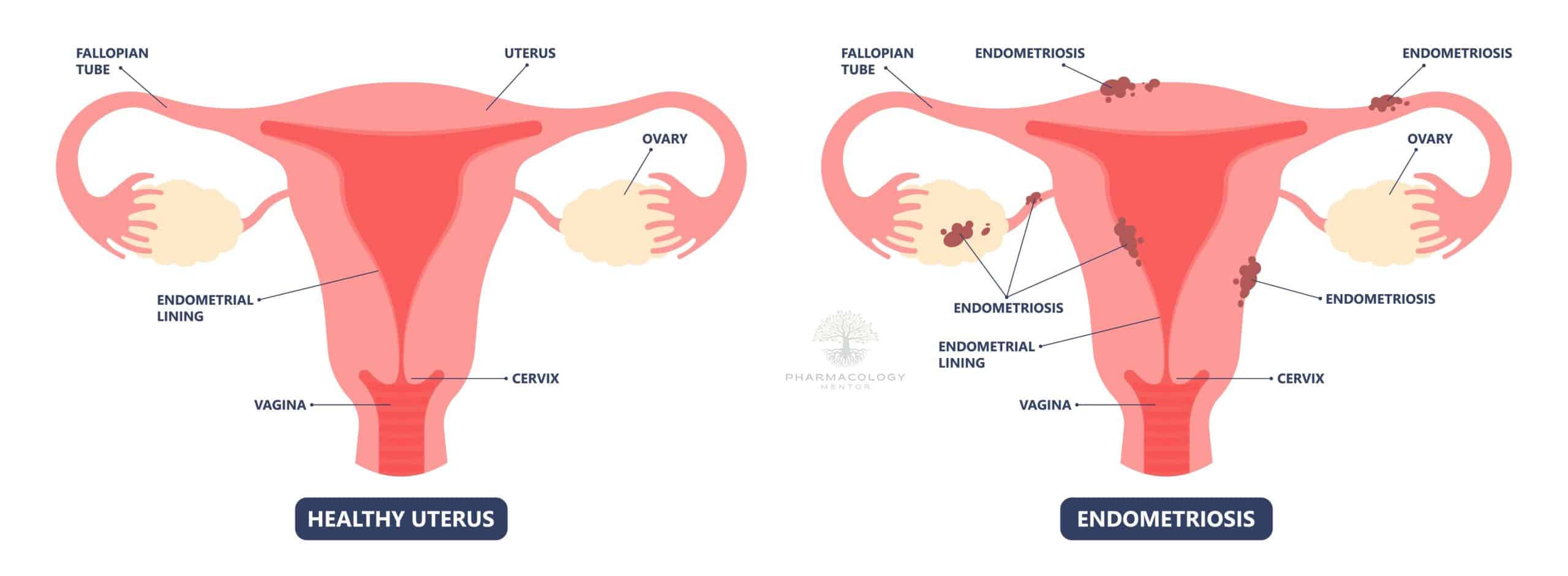 Linzagolix: Endometriosis pain pcos tissue cancer cyst pelvic ovary lining tissue cycle sex heavy tube