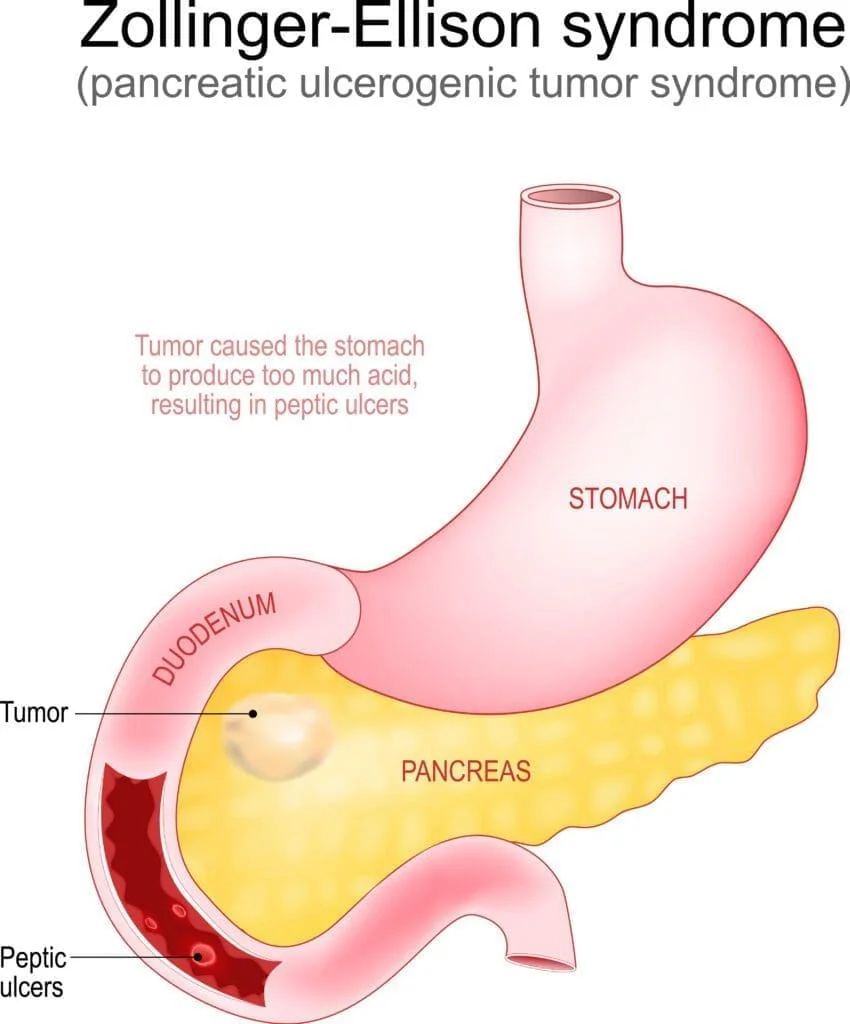 Zollinger-Ellison Syndrome