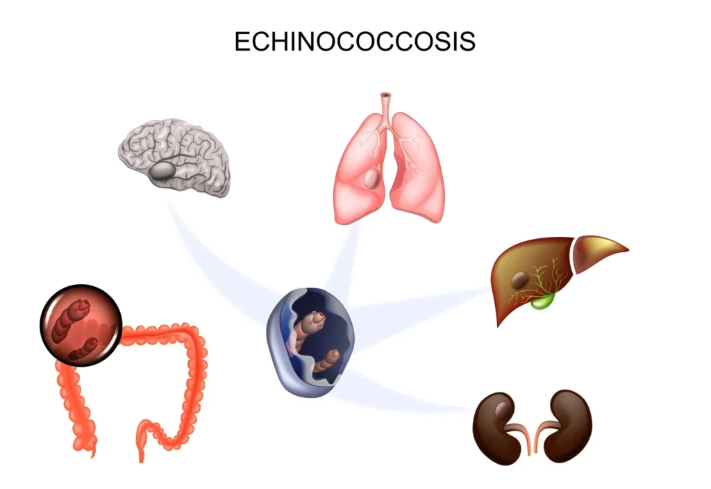 echinococcosis