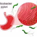 helicobacter_pylori