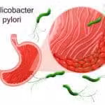 Helicobacter pylori