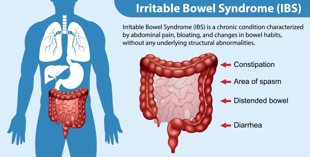 irritable bowel syndrome (IBS)