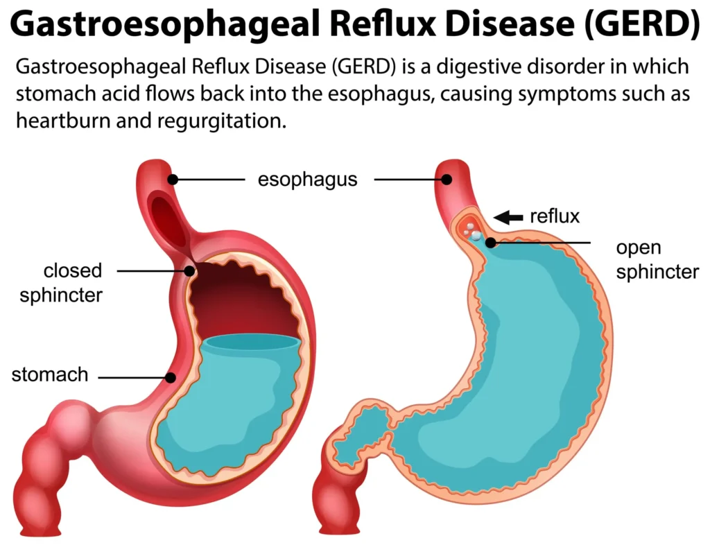 pathophysiology of GERD