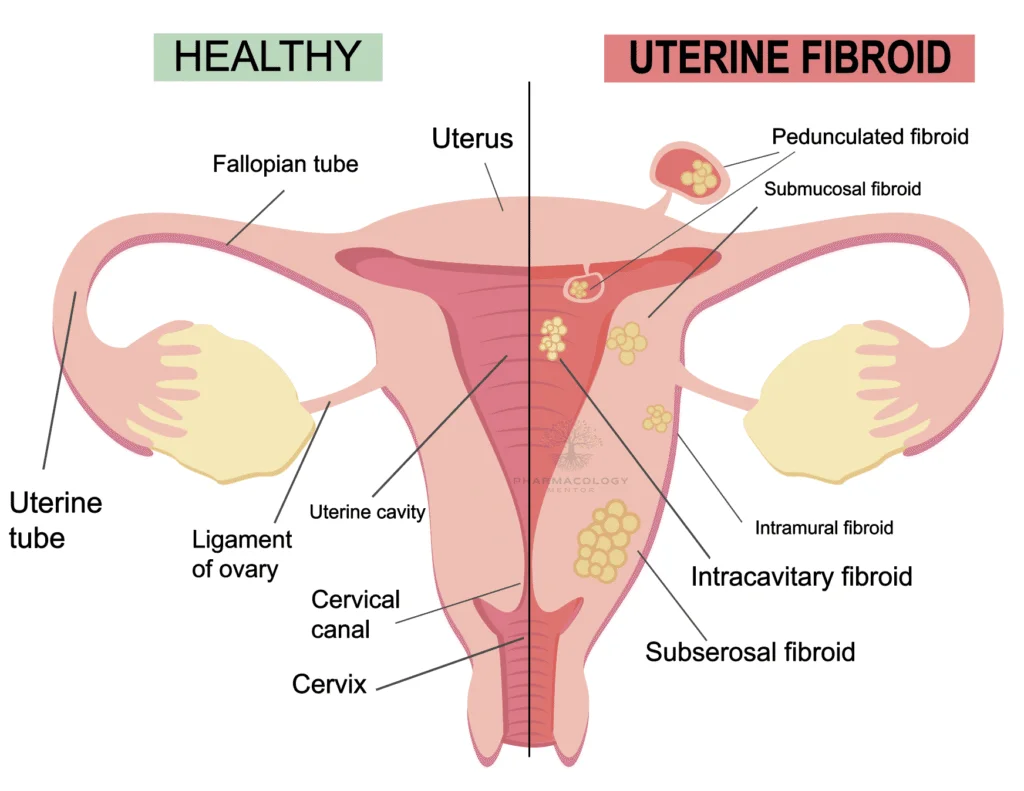 Linzagolix: uterine febroids