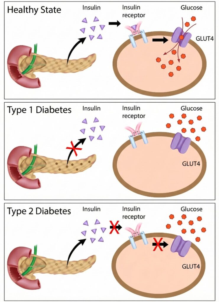 diabetes tyoe 1 and type 2