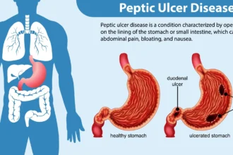 peptic ulcer disease (PUD)