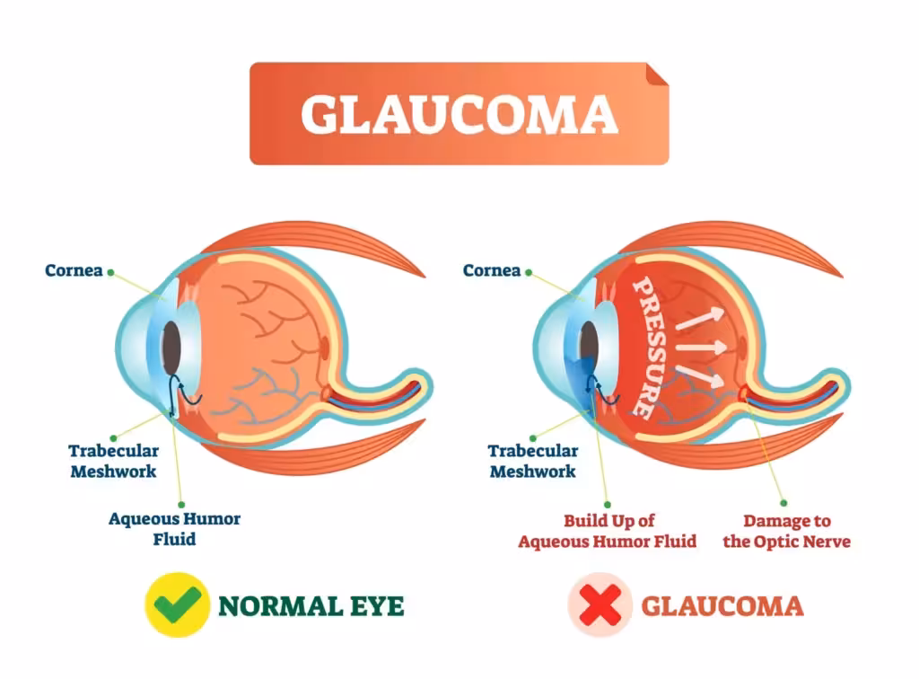 pharmacotherapy of glaucoma