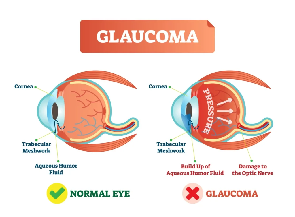 pharmacotherapy of glaucoma