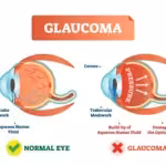 pharmacotherapy of glaucoma