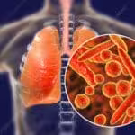 Mycoplasma pneumoniae