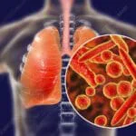 Mycoplasma pneumoniae