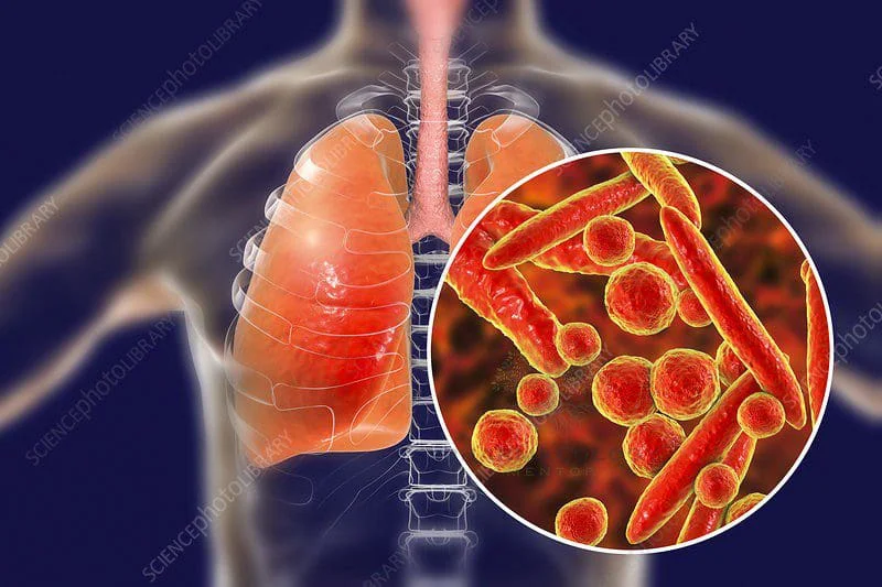 Mycoplasma pneumoniae