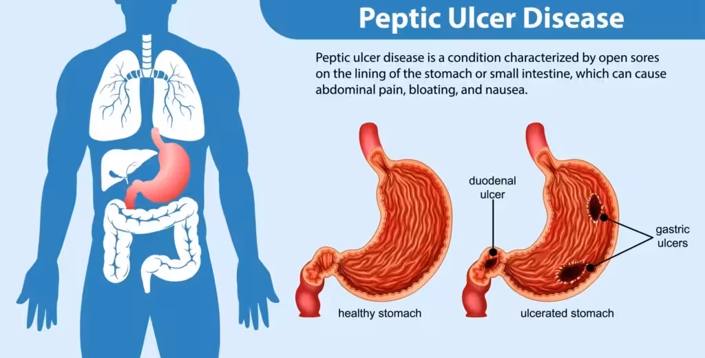 peptic ulcer disease