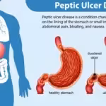 peptic ulcer disease