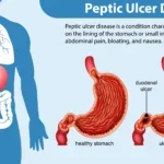 peptic ulcer disease