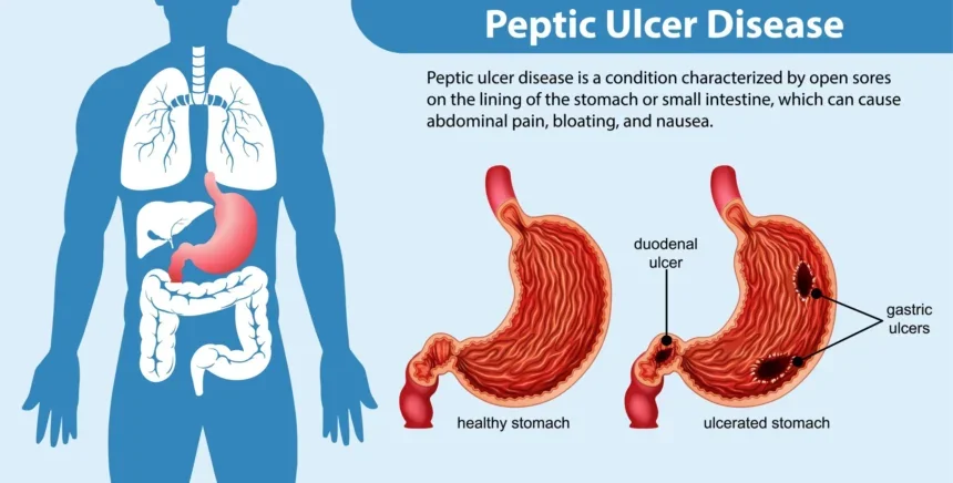 peptic ulcer disease